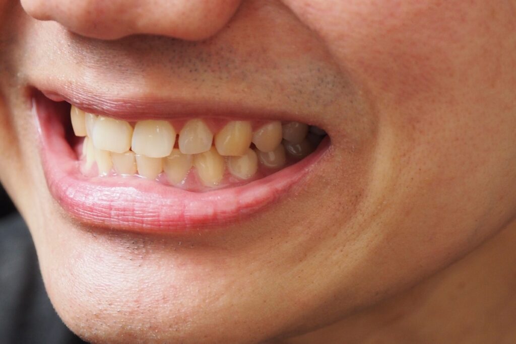 Causes and Treatment of Teeth Staining